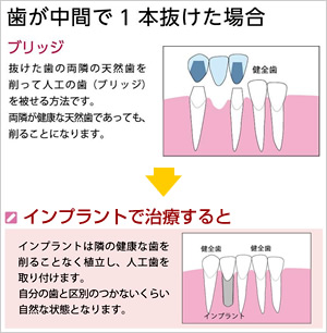 歯が中間で1本抜けた場合