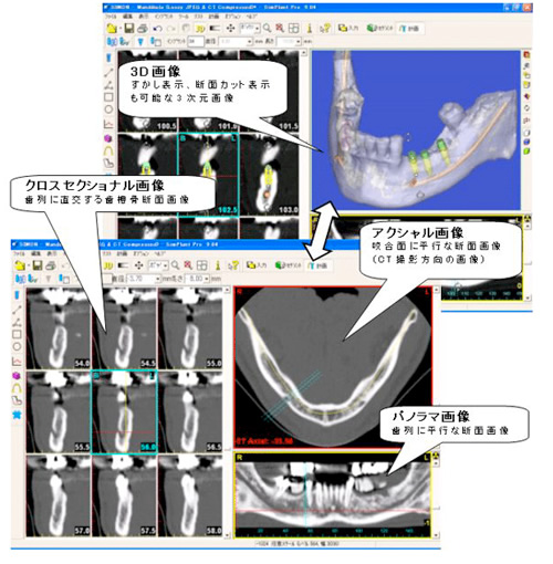 インプラントソフト