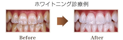 ホワイトニング診療例